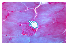 Ragged red fibers are a typical hallmark of mitochondrial myopathies